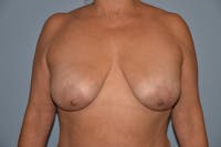 Breast Lift Before & After Gallery - Patient 30281368 - Image 1