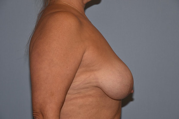 Breast Lift Before & After Gallery - Patient 30281368 - Image 5