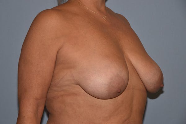 Breast Reduction Before & After Gallery - Patient 30281425 - Image 3