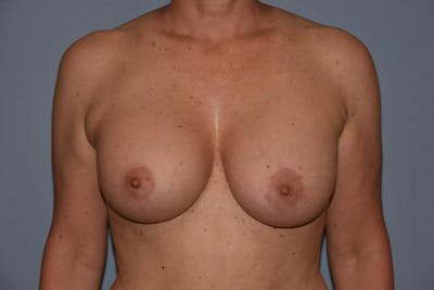 Breast Augmentation  Gallery - Patient 30283706 - Image 2