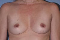 Breast Augmentation  Gallery - Patient 30283737 - Image 1