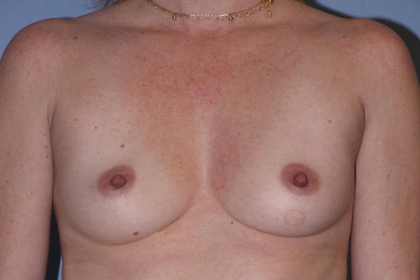 Breast Augmentation  Before & After Gallery - Patient 30283737 - Image 1
