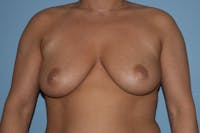 Breast Augmentation  Gallery - Patient 30283774 - Image 1