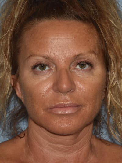 Facelift Before & After Gallery - Patient 32534061 - Image 2