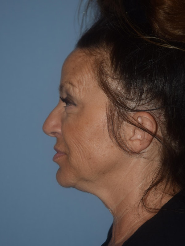 Facelift Before & After Gallery - Patient 32534061 - Image 3