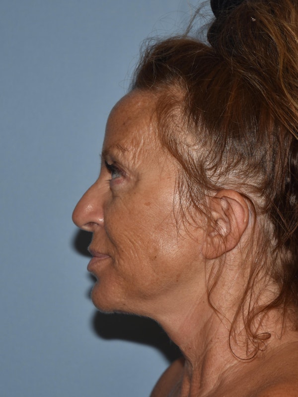 Facelift Before & After Gallery - Patient 32534061 - Image 4