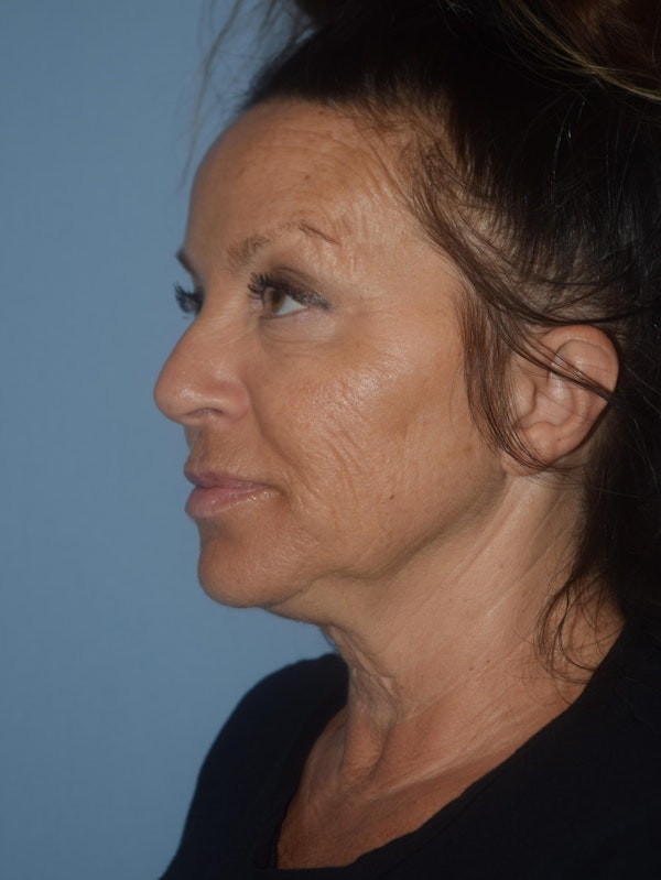 Facelift Before & After Gallery - Patient 32534061 - Image 5