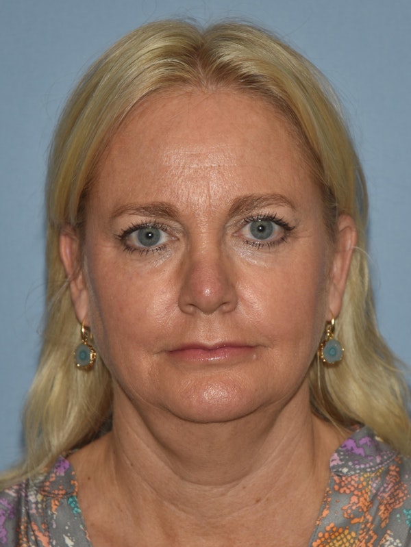 Facelift Before & After Gallery - Patient 32540126 - Image 1