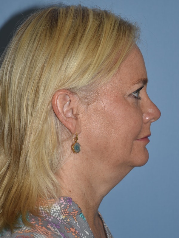 Facelift Before & After Gallery - Patient 32540126 - Image 5