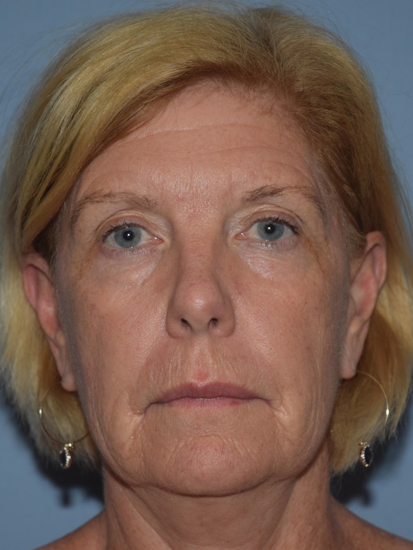 Facelift Before & After Gallery - Patient 32546281 - Image 1