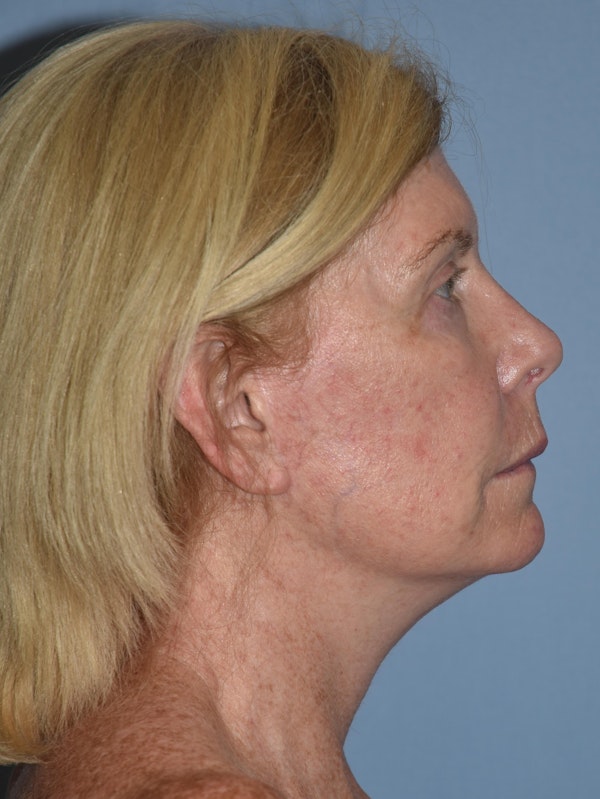 Facelift Before & After Gallery - Patient 32546281 - Image 6