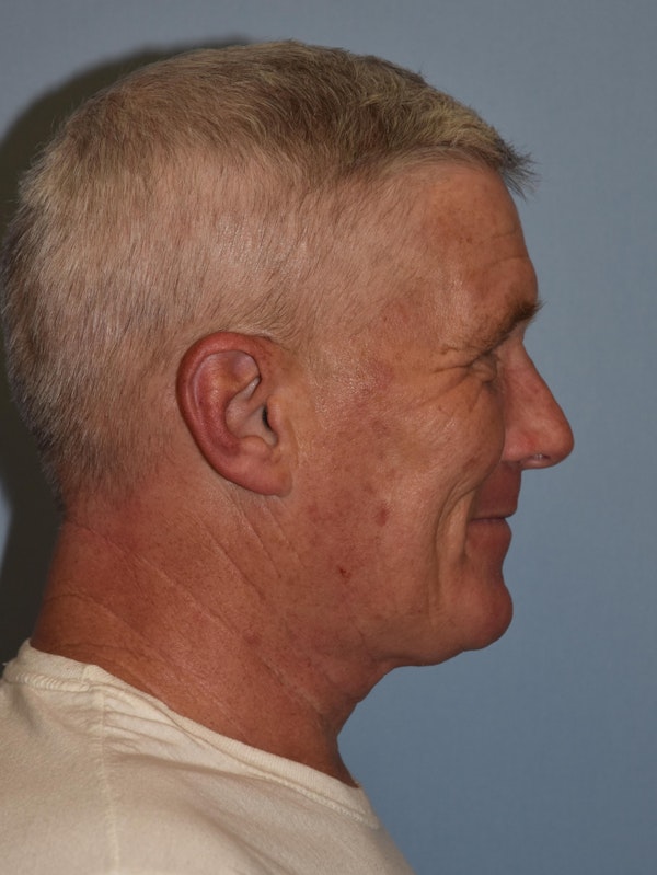 Facelift Before & After Gallery - Patient 32546366 - Image 3