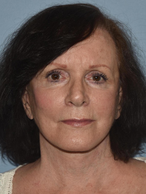 Facelift Before & After Gallery - Patient 32546406 - Image 2