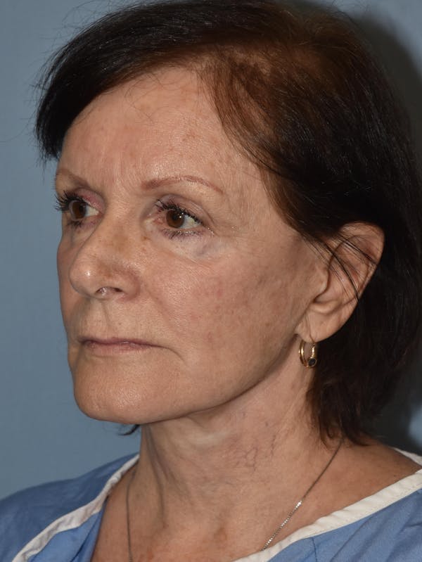 Facelift Before & After Gallery - Patient 32546406 - Image 3
