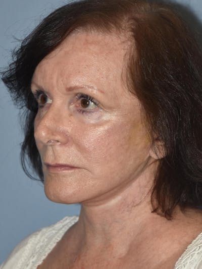 Facelift Before & After Gallery - Patient 32546406 - Image 4