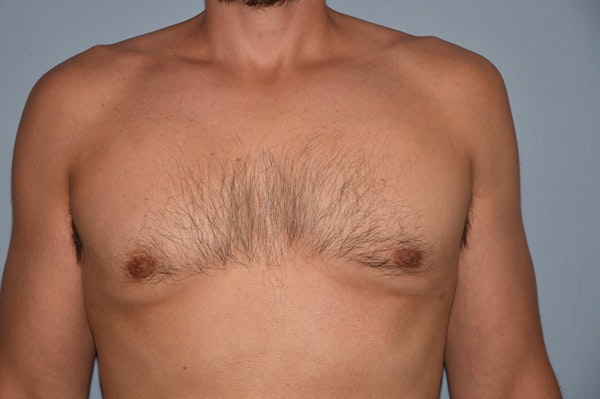 Gynecomastia Before & After Gallery - Patient 32546609 - Image 2