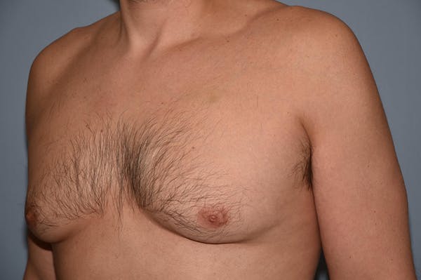 Gynecomastia Before & After Gallery - Patient 32546609 - Image 3