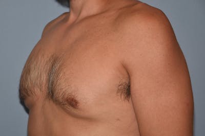 Gynecomastia Before & After Gallery - Patient 32546609 - Image 4