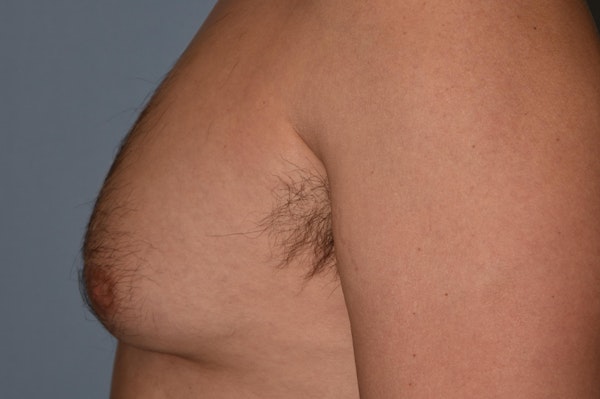 Gynecomastia Before & After Gallery - Patient 32546609 - Image 5
