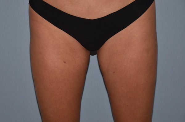 Liposuction Before & After Gallery - Patient 32552607 - Image 2