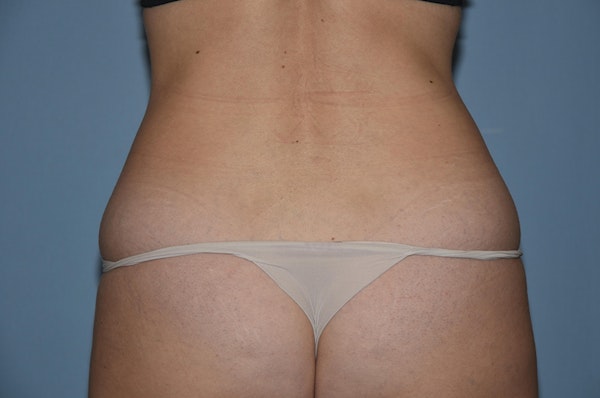 Liposuction Before & After Gallery - Patient 32552607 - Image 5