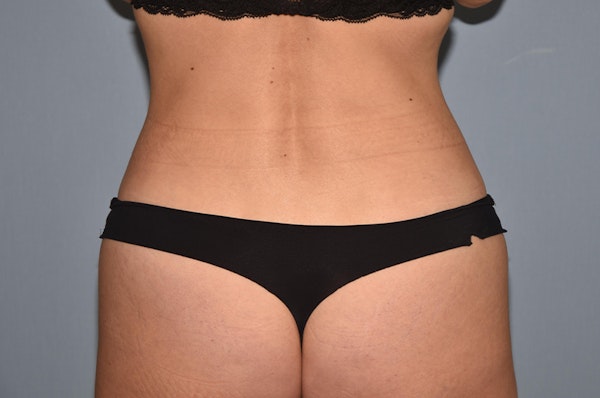 Liposuction Before & After Gallery - Patient 32552607 - Image 6