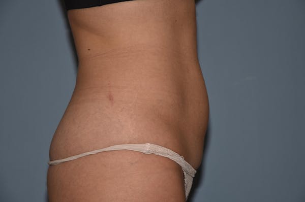 Liposuction Gallery - Patient 32552607 - Image 7