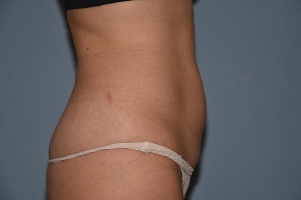 Liposuction Before & After Gallery - Patient 32552607 - Image 7