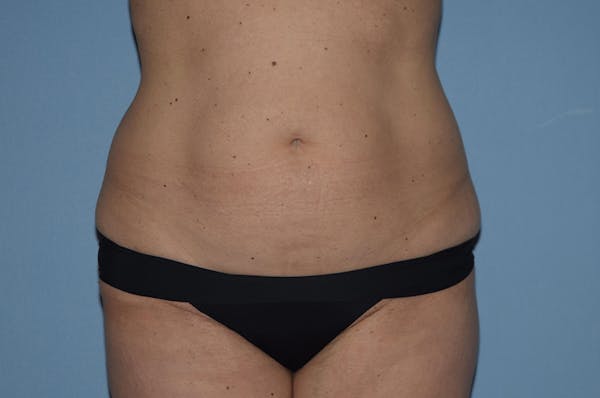 Liposuction Before & After Gallery - Patient 32552657 - Image 1