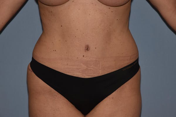 Liposuction Gallery - Patient 32552657 - Image 2
