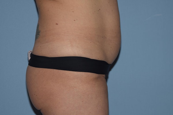Liposuction Before & After Gallery - Patient 32552657 - Image 3