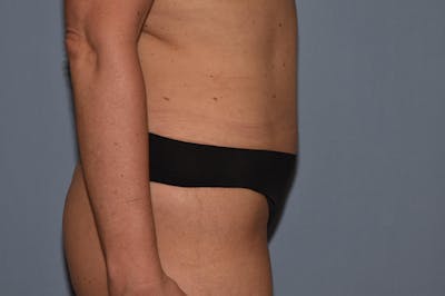 Liposuction Gallery - Patient 32552657 - Image 4