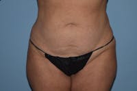 Liposuction Before & After Gallery - Patient 32552671 - Image 1