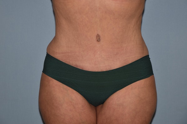 Liposuction Before & After Gallery - Patient 32552671 - Image 2