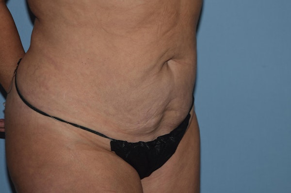 Liposuction Before & After Gallery - Patient 32552671 - Image 3