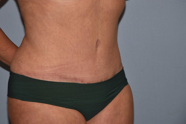 Liposuction Before & After Gallery - Patient 32552671 - Image 4