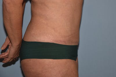 Liposuction Before & After Gallery - Patient 32552671 - Image 6
