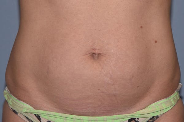 Liposuction Gallery - Patient 32552745 - Image 1