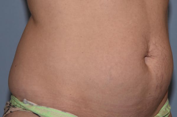Liposuction Gallery - Patient 32552745 - Image 3