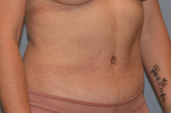 Liposuction Gallery - Patient 32552745 - Image 4
