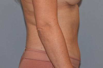 Liposuction Before & After Gallery - Patient 32552745 - Image 6