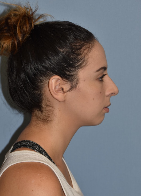 Rhinoplasty Before & After Gallery - Patient 32558874 - Image 1