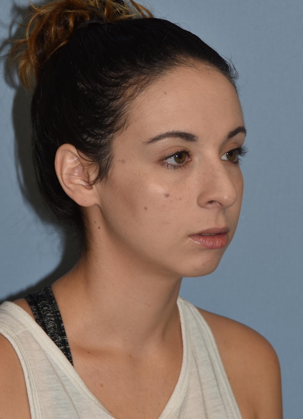 Rhinoplasty Before & After Gallery - Patient 32558874 - Image 3