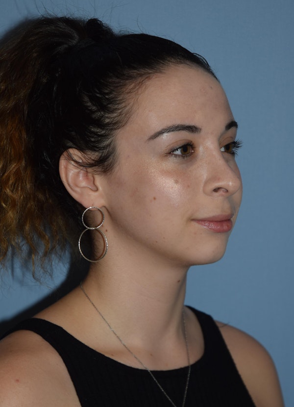 Rhinoplasty Before & After Gallery - Patient 32558874 - Image 4