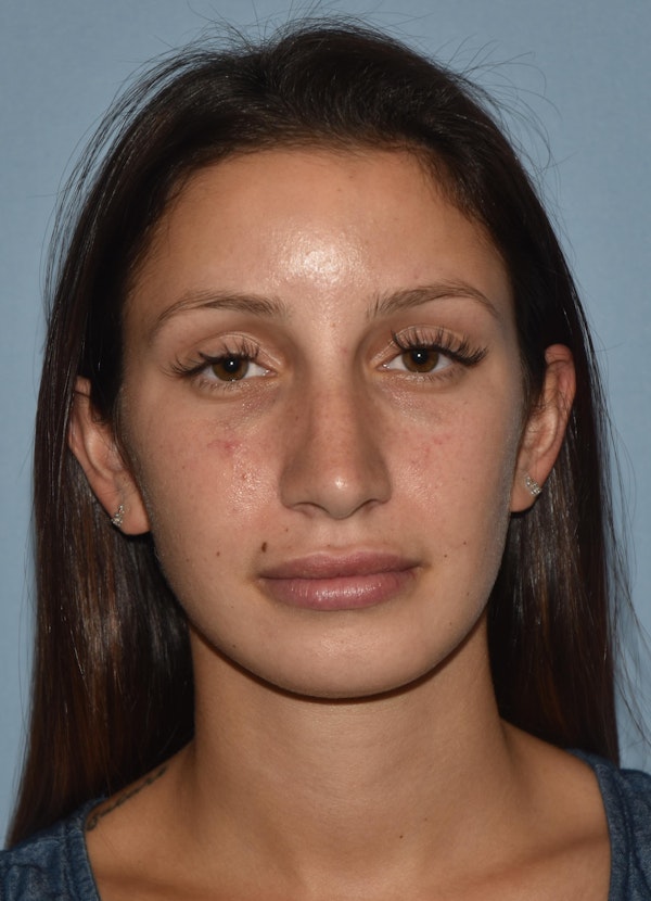Rhinoplasty Before & After Gallery - Patient 32565033 - Image 3