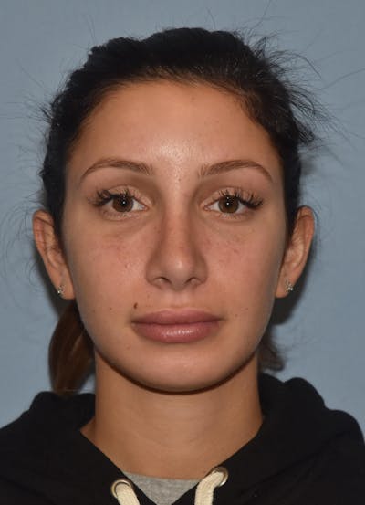 Rhinoplasty Before & After Gallery - Patient 32565033 - Image 4