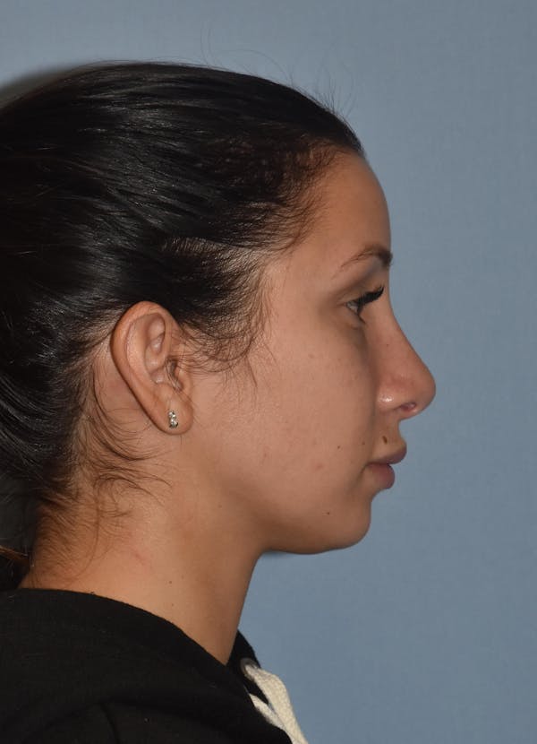 Rhinoplasty Before & After Gallery - Patient 32565033 - Image 4
