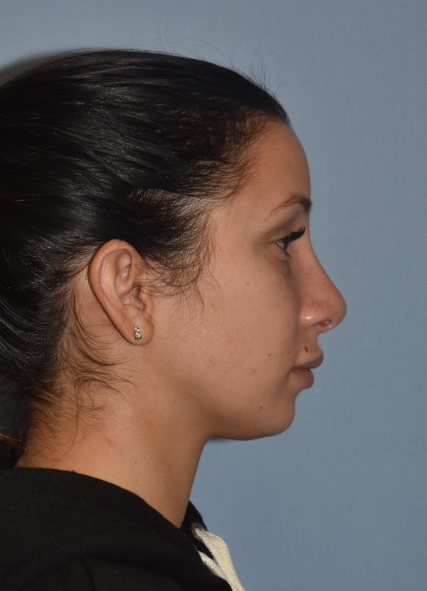 Rhinoplasty Before & After Gallery - Patient 32565033 - Image 2