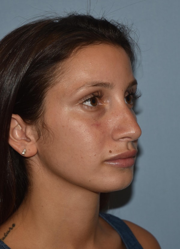 Rhinoplasty Before & After Gallery - Patient 32565033 - Image 5