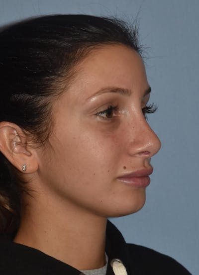 Rhinoplasty Before & After Gallery - Patient 32565033 - Image 6